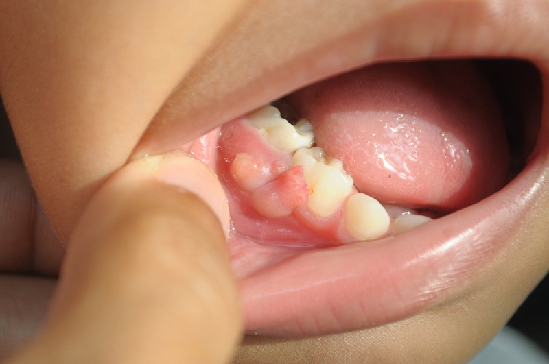 gum boil causes treatment and prevention