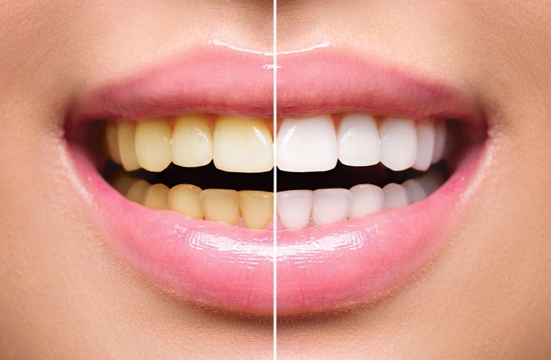 How to Clean Yellow Teeth at Home? Teeth Whitening Home Remedies
