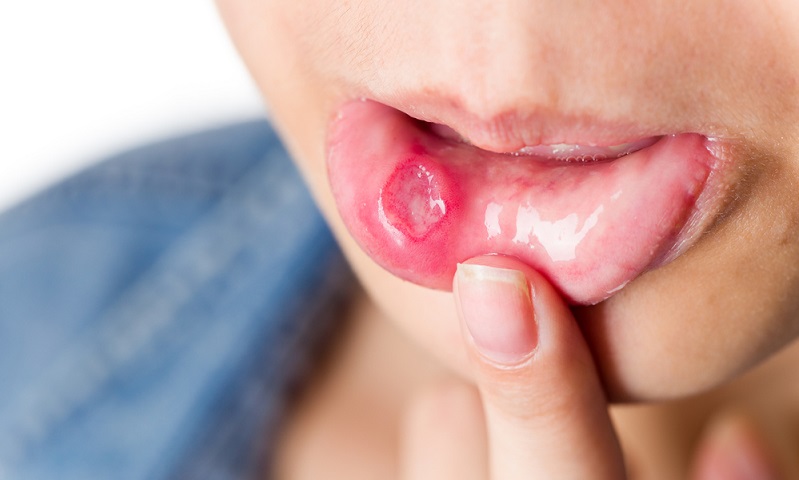 What are the Common Homeopathic Medicines for Mouth Ulcers