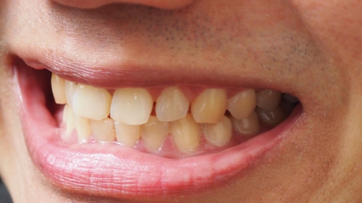 How to Remove Stains from Teeth?