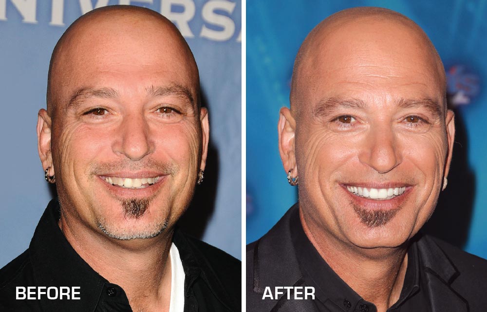 howie mandel before after dental implants veneers