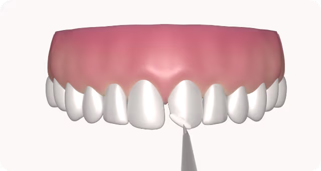 picture showing dental bonding process