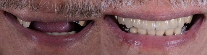 implant supported dentures before and after images
