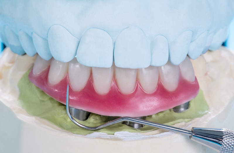 Implant Supported Overdenture: Procedure Steps, Classification and Cost