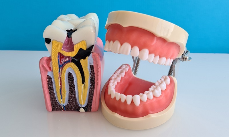 5 Signs of Infection After Root Canal: What You Need to Know