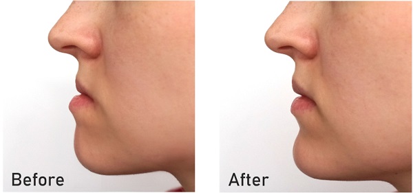 jaw surgery before and after image