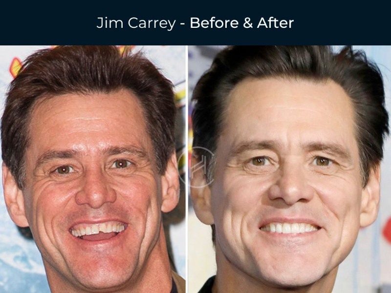 jim carry dental implants before after
