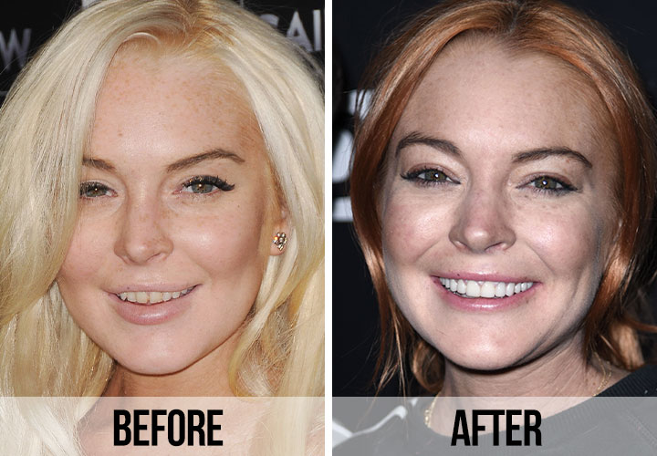 lindsay lohan teeth before and after dental implants