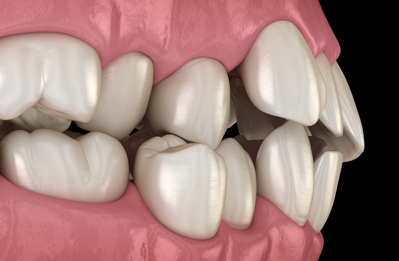 maloclussion teeth definition classes types and treatment