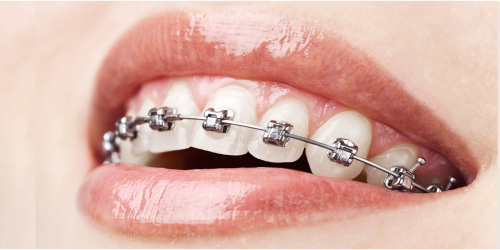 metal braces