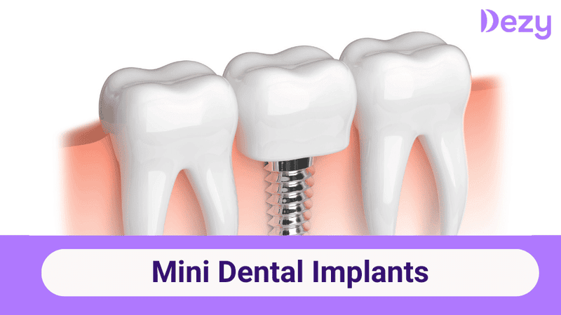 What Are Mini Dental Implants? Benefits, Cost & Procedure
