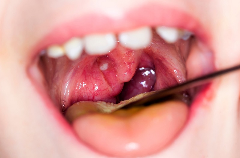 Mouth Infections: Symptoms, Causes & Treatments You Shouldn't Ignore