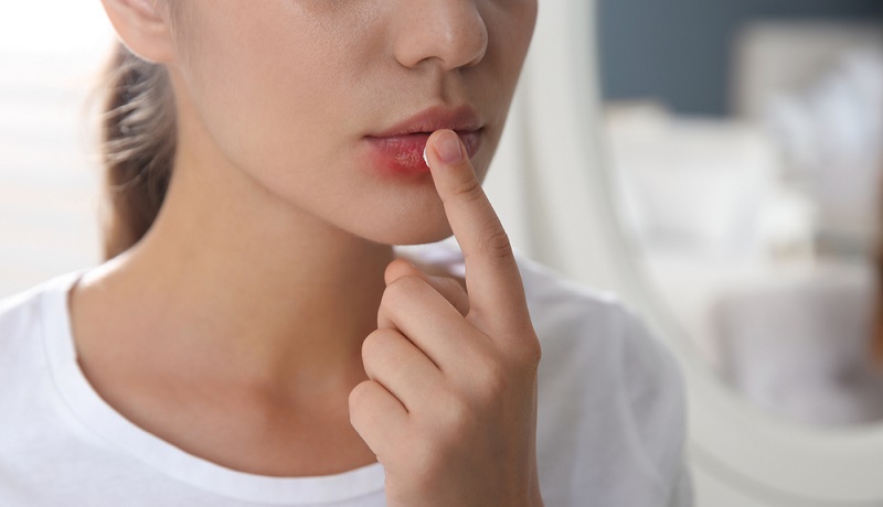 Mouth Ulcer: Causes, Symptoms and How to Get Rid of Them?