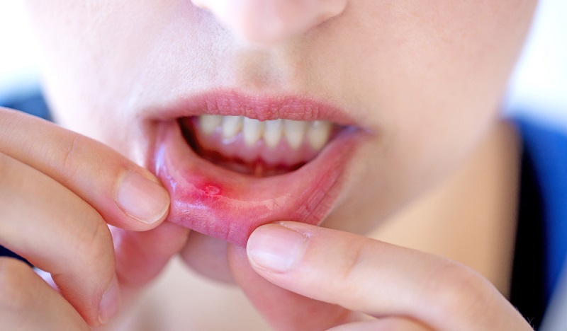What are the Types of Mouth Ulcers and How to Treat Them?