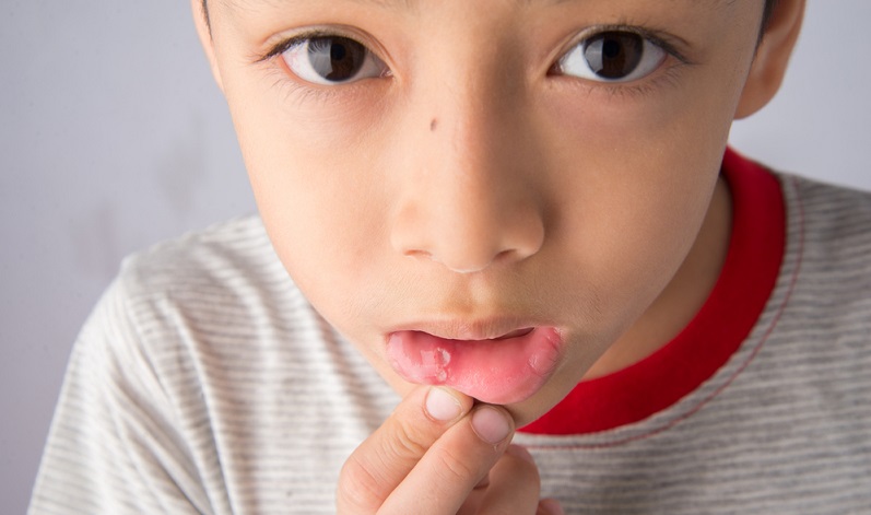 Mouth Ulcer in Kids: How To Treat Mouth Ulcer In Children?