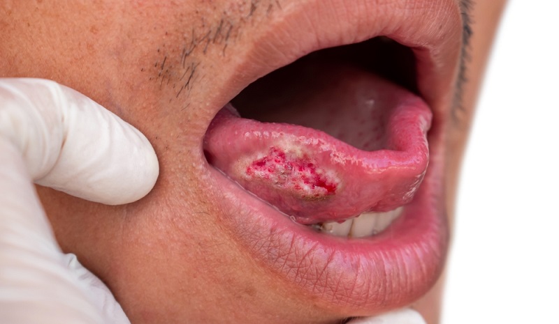 Oral Cancer Stages: Different Stages, Complications & Survival Rate