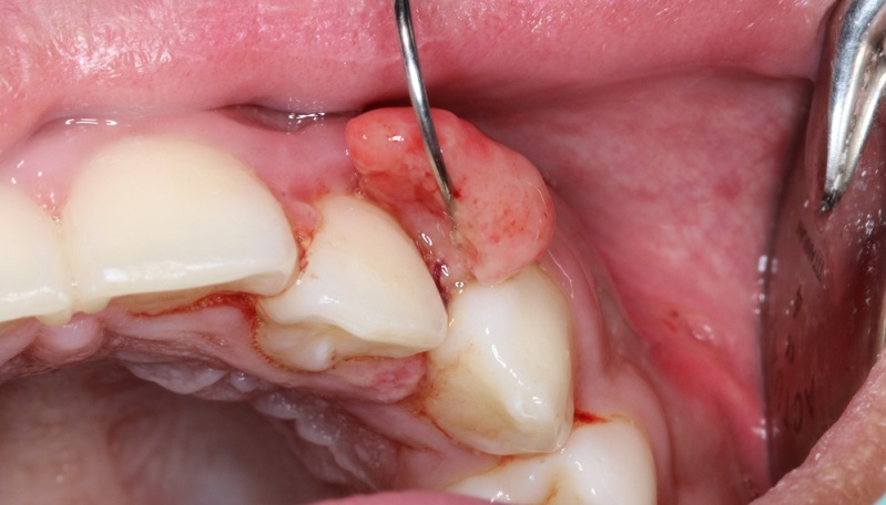 Oral Cancer vs Mouth Ulcer: What is The Difference?