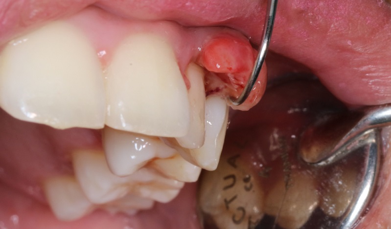 Oral Cavity Cancer: Symptoms, Causes, Stages and Treatment