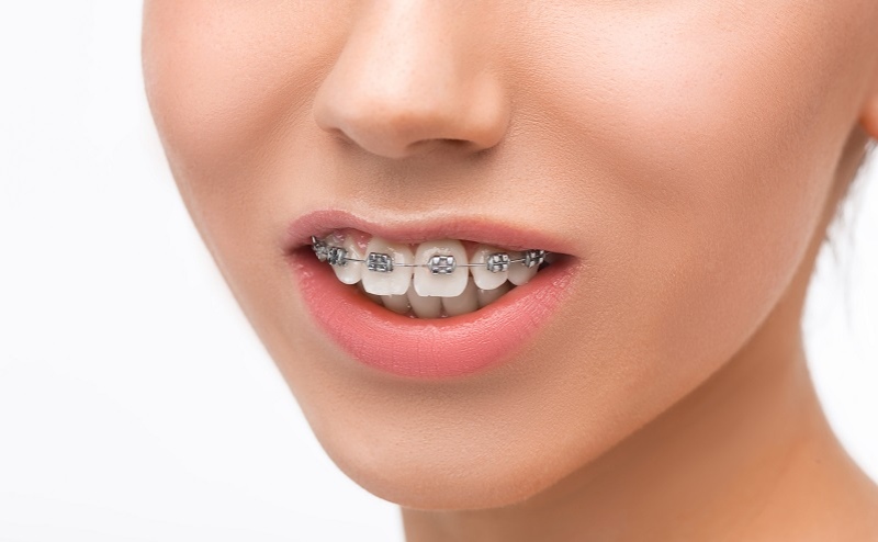 overbite before and after braces