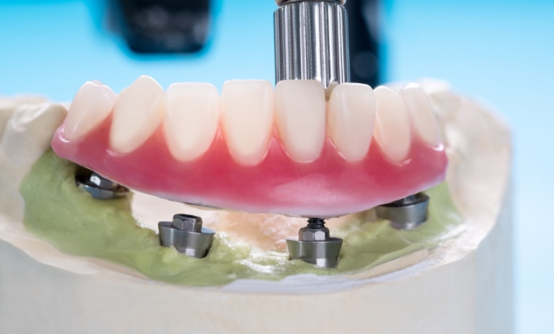 What are Overdentures? Procedure, Types, Cost and More