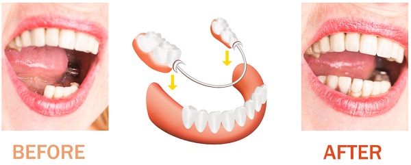 partial dentures before and after pictures