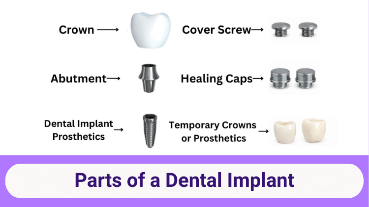 Parts of a Dental Implant: Components, Functions & How They Work