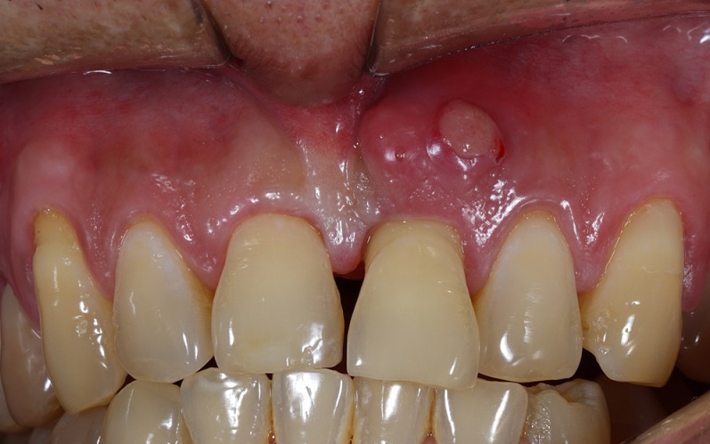 Periodontal Abscess: Symptoms, Causes & Treatment Options
