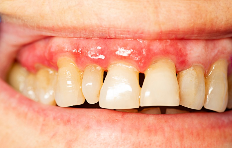 Periodontal (Gum) Disease: What Is It? Symptoms, Classification, and Treatment