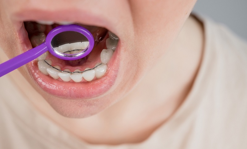 Everything You Need to Know About Permanent Retainers