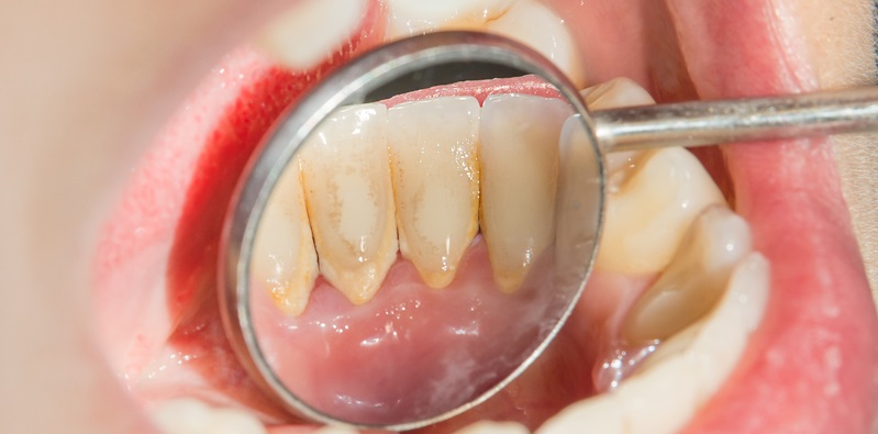 Plaque vs Tartar: Key Differences & How to Prevent Both