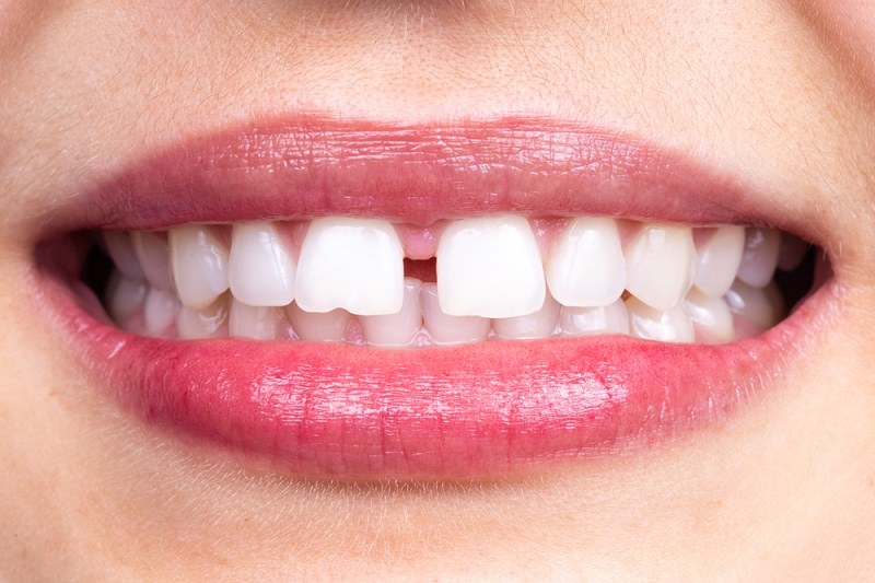 close gaps between teeth naturally at home