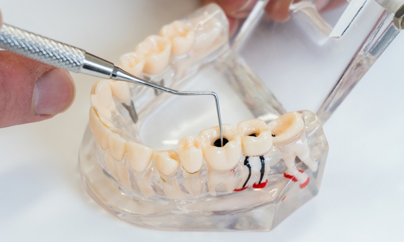 Root Canal Treatment: Benefits, Aftercare and How Safe Is It?