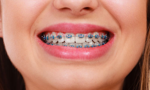 self ligating braces