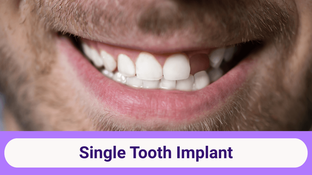 Single Tooth Implant in India: Cost, Procedure, Recovery & Benefits