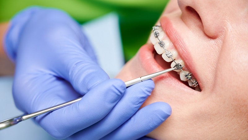 What are the Ways to Straighten Teeth without Braces?