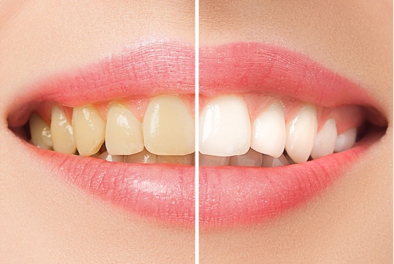 Teeth Bleaching: Procedure, Side Effects, Results and Cost in India