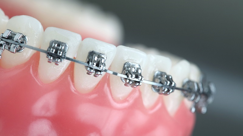 Teeth Braces: What Are They, and How Do They Work?