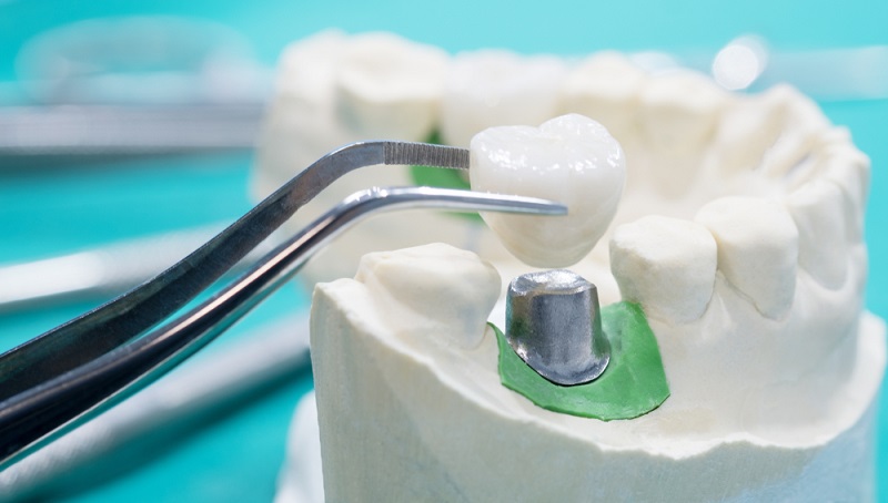 Teeth Crowns vs Veneers: What's Better and Which One Should You Get?