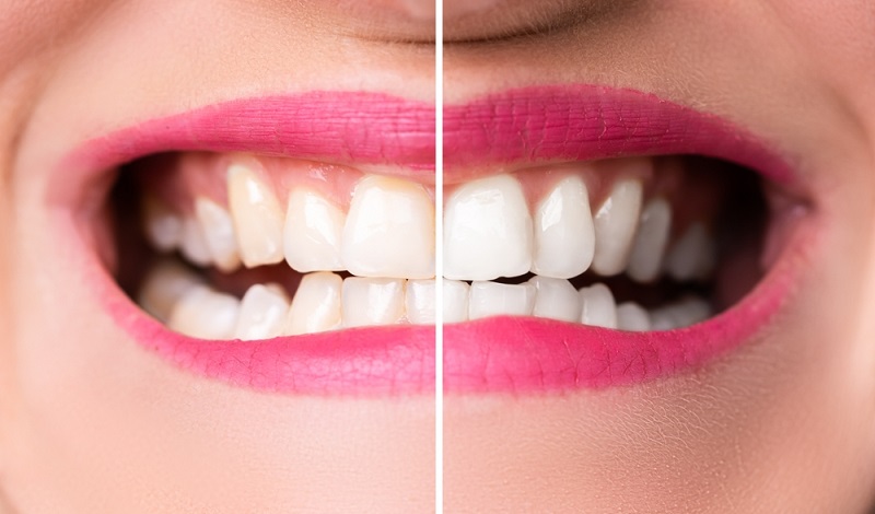 Teeth Whitening Before and After Treatment Picture Results