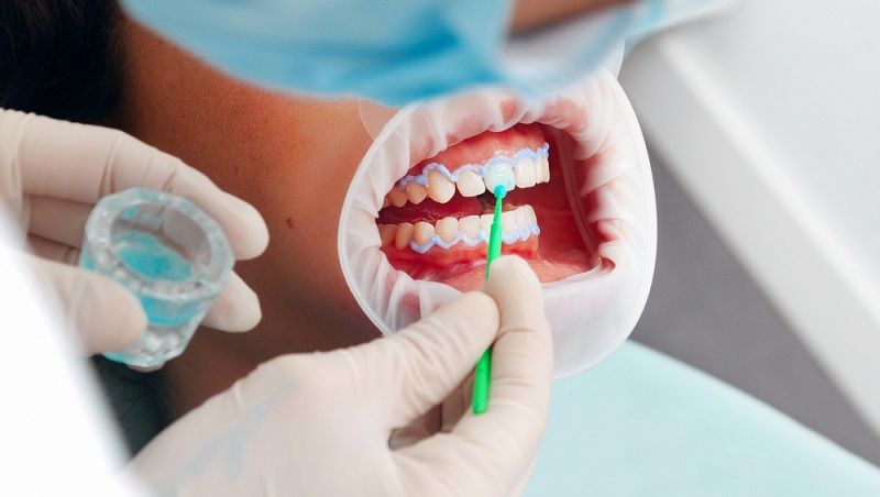 The Ultimate Guide to Teeth Whitening: Strips, Powder, Gel, Toothpaste and More