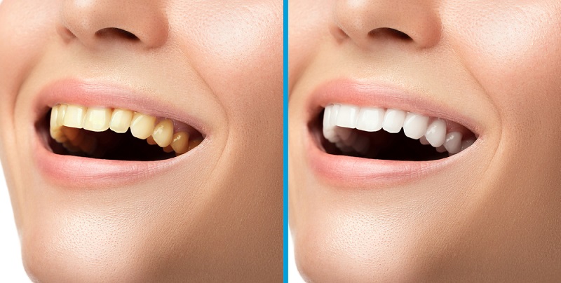What Are Teeth Whitening Side Effects? - The Must-Know Truths