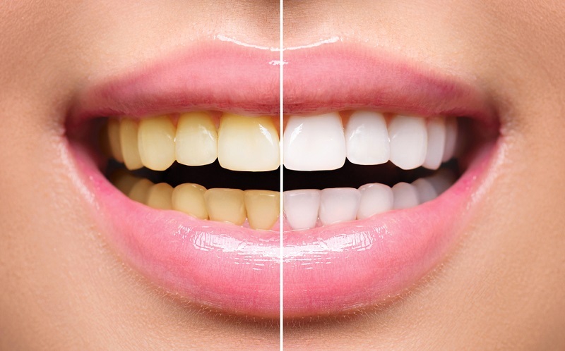 Best Teeth Whitening Tips From An Expert Dentist