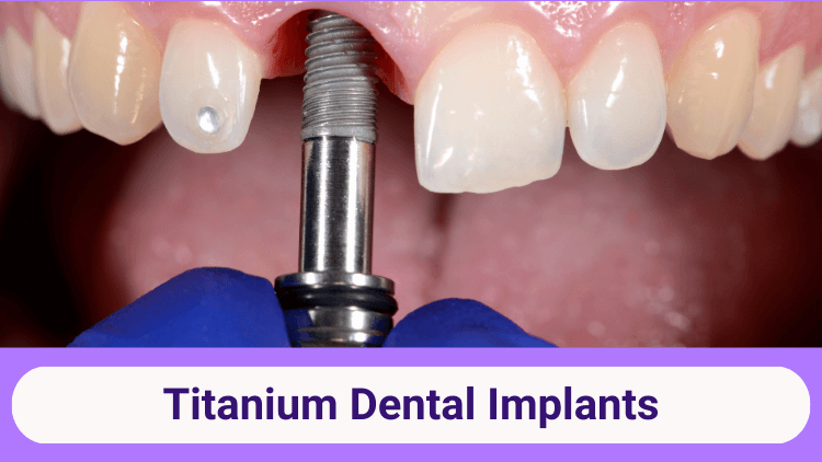 Titanium Dental Implants