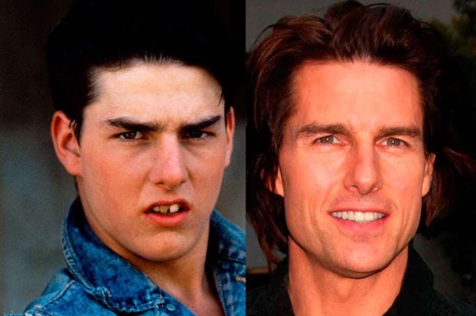 tom cruise before and after dental implants