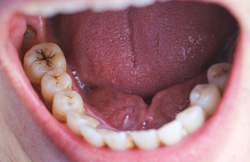 How Tooth Caries Impact Your Life at the Workplace?