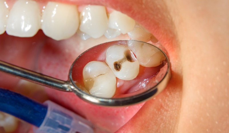 Tooth Cavities: Causes, Symptoms & How to Treat Them