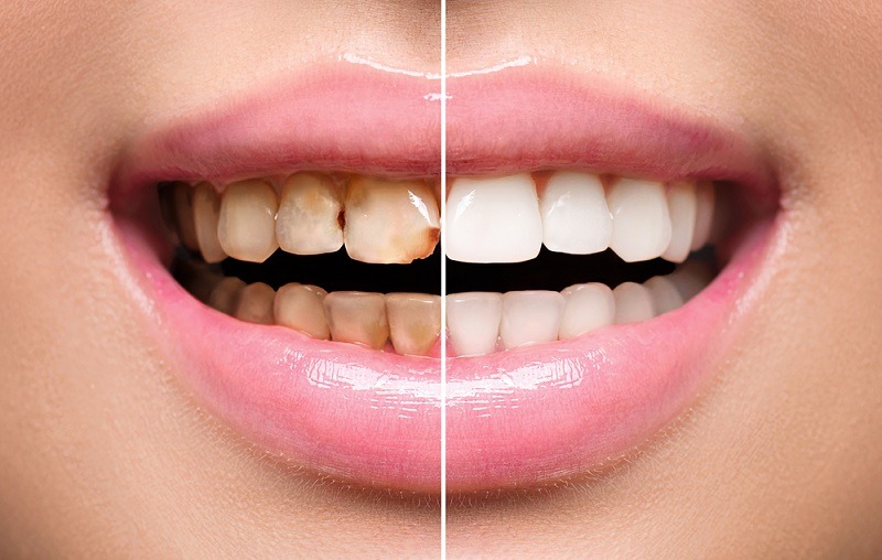what is the difference tooth cavity vs stains
