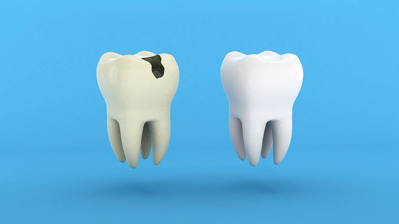 Tooth Decay: Symptoms, Stages & Treatment You Need to Know