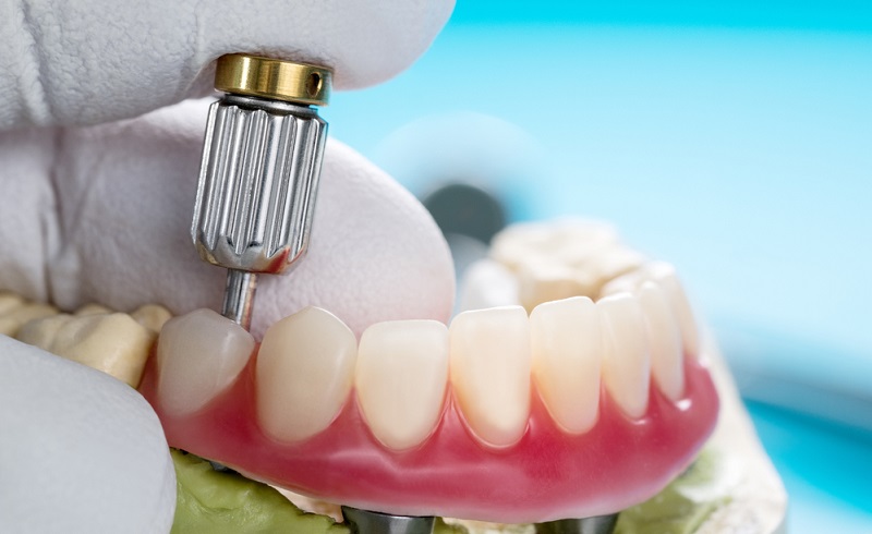 A Guide to Tooth-Supported Overdentures: Cost, Types, and Benefits