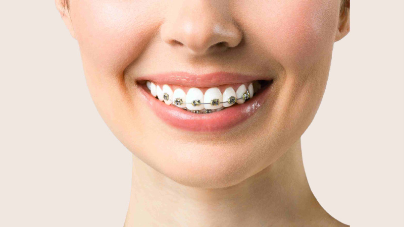 types of dental braces